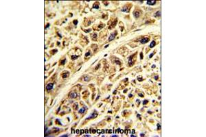 Formalin-fixed and paraffin-embedded human hepatocarcinoma with PRELP Antibody , which was peroxidase-conjugated to the secondary antibody, followed by DAB staining. (PRELP Antikörper  (C-Term))