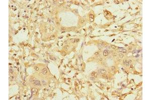 Immunohistochemistry of paraffin-embedded human pancreatic cancer using ABIN7146024 at dilution of 1:100 (SPAG9 Antikörper  (N-Term))