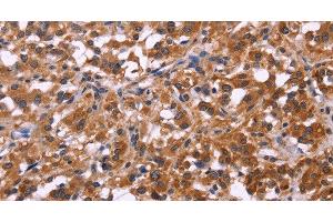 Immunohistochemistry of paraffin-embedded Human thyroid cancer tissue using SPATA7 Polyclonal Antibody at dilution 1:30 (SPATA7 Antikörper)