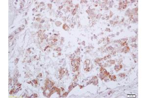 Formalin-fixed and paraffin embedded human liver carcinoma labeled with Anti-Phospho-PKM2 (Tyr105) Polyclonal Antibody, Unconjugated (ABIN744773) at 1:200 followed by conjugation to the secondary antibody and DAB staining (PKM2 Antikörper  (pTyr105))