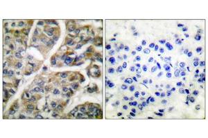 Immunohistochemical analysis of paraffin-embedded human breast carcinoma tissue using Granzyme B antibody (ABIN2843546). (GZMB Antikörper  (N-Term))