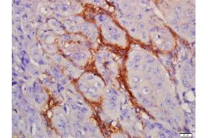 Formalin-fixed and paraffin embedded human laryngocarcinoma labeled with Anti-EGFRvIII Polyclonal Antibody, Unconjugated  at 1:200 followed by conjugation to the secondary antibody and DAB staining (EGFRviii Antikörper  (AA 1-50))