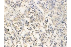 ABIN6260726 and ABIN6266946 at 1/100 staining human lung squamous cell carcinoma by IHC-P. (CDKL4 Antikörper  (Internal Region))