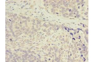 Immunohistochemistry of paraffin-embedded human gastric cancer using ABIN7143283 at dilution of 1:100 (ADA Antikörper  (AA 157-343))
