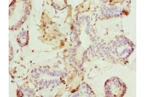 Immunohistochemistry of paraffin-embedded human breast cancer using ABIN7165308 at dilution of 1:100 (DR1 Antikörper  (AA 1-176))