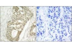 Immunohistochemistry analysis of paraffin-embedded human breast carcinoma, using PKC delta (Phospho-Ser645) Antibody. (PKC delta Antikörper  (pSer645))