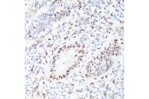 Immunohistochemistry of paraffin-embedded human appendix using P-MYC-S62 antibody (ABIN3019544, ABIN3019545, ABIN3019546 and ABIN6225456) at dilution of 1:100 (40x lens). (c-MYC Antikörper  (pSer62))