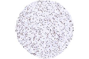 Clear cell renal cell carcinoma with strong Histone H3 staining of tumor cells (Histone 3 Antikörper)