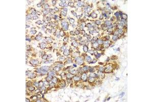 Immunohistochemistry of paraffin-embedded human esophageal cancer using TFAM antibody. (TFAM Antikörper  (AA 1-220))