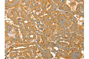 The image on the left is immunohistochemistry of paraffin-embedded Human thyroid cancer tissue using ABIN7130772(PTPN22 Antibody) at dilution 1/30, on the right is treated with fusion protein. (PTPN22 Antikörper)