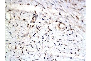 Formalin-fixed and paraffin embedded keloid tissue labeled with Anti-iASPP Polyclonal Antibody, Unconjugated (ABIN727280) followed by conjugation to the secondary antibody and DAB staining (PPP1R13L Antikörper  (AA 15-100))