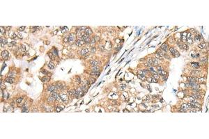 Immunohistochemistry of paraffin-embedded Human gastric cancer tissue using BLNK Polyclonal Antibody at dilution of 1:40(x200) (B-Cell Linker Antikörper)