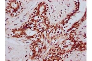 IHC image of ABIN7164169 diluted at 1:400 and staining in paraffin-embedded human breast cancer performed on a Leica BondTM system. (DHX38 Antikörper  (AA 113-280))