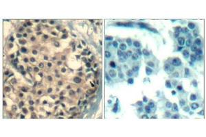 Immunohistochemical analysis of paraffin-embedded human breast carcinoma tissue using HDAC4/HDAC5/HDAC9(Phospho-Ser246/259/220) Antibody(left) or the same antibody preincubated with blocking peptide(right). (HDAC4/HDAC5/HDAC9 Antikörper  (pSer220, pSer246, pSer259))