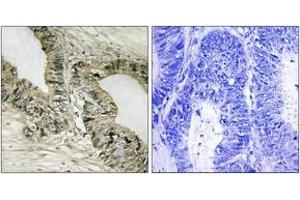 Immunohistochemistry analysis of paraffin-embedded human colon carcinoma tissue, using Gab2 (Ab-159) Antibody. (GAB2 Antikörper  (AA 125-174))
