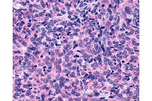 Anti-P2Y10 / P2RY10 antibody IHC of human Lung, Small Cell Carcinoma.