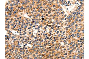 The image on the left is immunohistochemistry of paraffin-embedded Human liver cancer tissue using ABIN7191765(PAFAH1B1 Antibody) at dilution 1/25, on the right is treated with synthetic peptide. (PAFAH1B1 Antikörper)