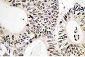 Immunohistochemistry (IHC) analyzes of p53 antibody in paraffin-embedded human colon carcinoma tissue. (p53 Antikörper)