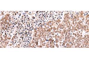 Immunohistochemistry of paraffin-embedded Human lung cancer tissue using RCOR3 Polyclonal Antibody at dilution of 1:60(x200) (RCOR3 Antikörper)
