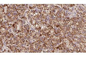 ABIN6279611 at 1/100 staining Human liver cancer tissue by IHC-P. (GPM6A Antikörper  (Internal Region))