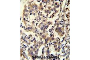 CCDC110 Antibody (C-term) immunohistochemistry analysis in formalin fixed and paraffin embedded human testis carcinoma followed by peroxidase conjugation of the secondary antibody and DAB staining. (CCDC110 Antikörper  (C-Term))