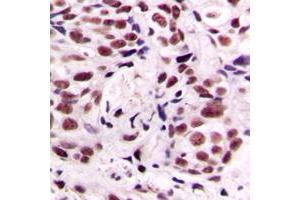 Immunohistochemical analysis of CREB (pS133) staining in human breast cancer formalin fixed paraffin embedded tissue section. (CREB1 Antikörper  (pSer133))