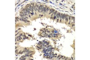 Immunohistochemistry of paraffin-embedded human colon carcinoma using RBBP5 antibody. (RBBP5 Antikörper  (AA 319-538))