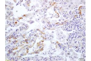 Formalin-fixed and paraffin embedded human lung carcinoma labeled with Anti Integrin alpha V/CD51 Polyclonal Antibody (ABIN678983), Unconjugated at 1:200, followed by conjugation to the secondary antibody and DAB staining (CD51 Antikörper  (AA 51-150))