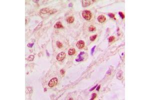 Immunohistochemical analysis of DJ-1 staining in human lung cancer formalin fixed paraffin embedded tissue section. (PARK7/DJ1 Antikörper  (Center))