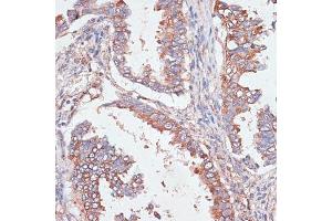 Immunohistochemistry of paraffin-embedded human lung cancer using G antibody  at dilution of 1:100 (40x lens). (GAB1 Antikörper  (AA 1-150))