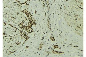 ABIN6273229 at 1/100 staining Human breast cancer tissue by IHC-P. (DOM3Z Antikörper  (Internal Region))