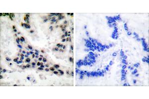 Peptide - +Immunohistochemical analysis of paraffin-embedded human lung carcinoma tissue using HDAC1 antibody (#C0221). (HDAC1 Antikörper)