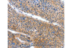 Immunohistochemistry of Human lung cancer using ARL11 Polyclonal Antibody at dilution of 1:50