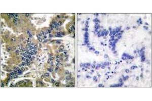 Immunohistochemistry analysis of paraffin-embedded human lung carcinoma tissue, using IL-1 beta (Cleaved-Asp210) Antibody. (IL-1 beta Antikörper  (Cleaved-Asp210))