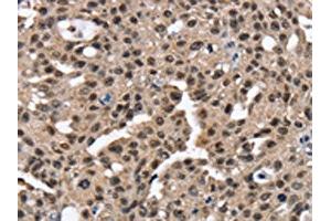 The image on the left is immunohistochemistry of paraffin-embedded Human breast cancer tissue using ABIN7130904(RNF40 Antibody) at dilution 1/25, on the right is treated with fusion protein. (RNF4 Antikörper)