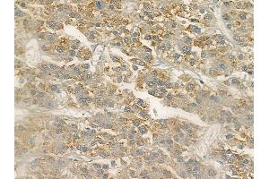 ABIN6256678 and ABIN6267101 at 1/100 staining human hepatocellular carcinoma by IHC-P. (CAMKII gamma Antikörper  (pTyr231))