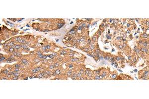 Immunohistochemistry of paraffin-embedded Human liver cancer tissue using ATP5C1 Polyclonal Antibody at dilution of 1:55(x200) (ATP5C1 Antikörper)