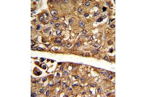 Formalin-fixed and paraffin-embedded human hepatocarcinoma reacted with MDH1 Antibody (C-term), which was peroxidase-conjugated to the secondary antibody, followed by DAB staining. (MDH1 Antikörper  (C-Term))