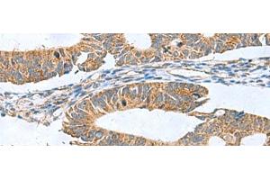Immunohistochemistry of paraffin-embedded Human colorectal cancer tissue using CLEC1B Polyclonal Antibody at dilution of 1:60(x200) (C-Type Lectin Domain Family 1, Member B (CLEC1B) Antikörper)