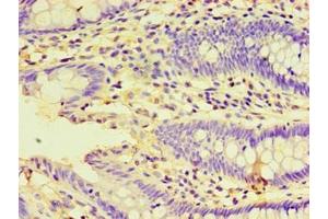 Immunohistochemistry of paraffin-embedded human colon cancer using ABIN7155929 at dilution of 1:100 (HSPBAP1 Antikörper  (AA 1-488))