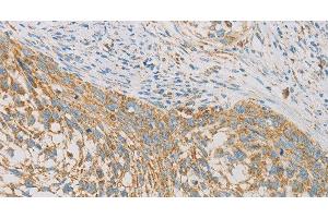 Immunohistochemistry of paraffin-embedded Human cervical cancer tissue using REN Polyclonal Antibody at dilution 1:40 (Renin Antikörper)