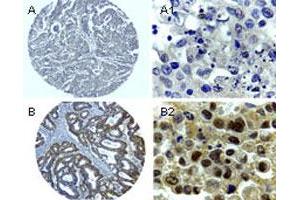 Formalin-fixed, paraffin-embedded sections of human colorectal cancer stained for Bag1.