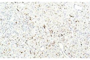 Immunohistochemistry of paraffin-embedded Human breast carcinoma tissue using JAK1 Monoclonal Antibody at dilution of 1:200. (JAK1 Antikörper)