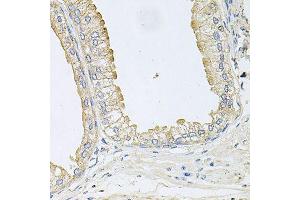 Immunohistochemistry of paraffin-embedded human prostate using ANKH antibody (ABIN6003613) at dilution of 1/100 (40x lens). (ANKH Antikörper)