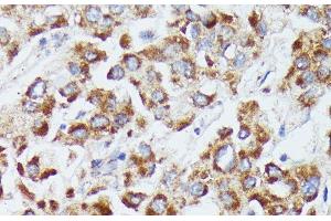 Immunohistochemistry of paraffin-embedded Human liver cancer using DUT Polyclonal Antibody at dilution of 1:100 (40x lens).