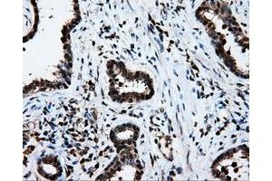 Immunohistochemical staining of paraffin-embedded Adenocarcinoma of ovary tissue using anti-LTA4H mouse monoclonal antibody. (LTA4H Antikörper)