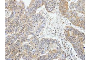 IHC-P Image Immunohistochemical analysis of paraffin-embedded human gastric cancer, using RIP2, antibody at 1:100 dilution. (RIPK2 Antikörper)