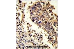 Formalin-fixed and paraffin-embedded human lung carcinoma reacted with LUC7L Antibody (C-term), which was peroxidase-conjugated to the secondary antibody, followed by DAB staining. (LUC7L Antikörper  (C-Term))