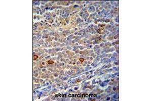 C9orf156 Antibody immunohistochemistry analysis in formalin fixed and paraffin embedded human skin carcinoma followed by peroxidase conjugation of the secondary antibody and DAB staining.