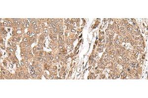 Immunohistochemistry of paraffin-embedded Human liver cancer tissue using MAGOHB Polyclonal Antibody at dilution of 1:70(x200) (Mago Nashi Homolog 2 Antikörper)